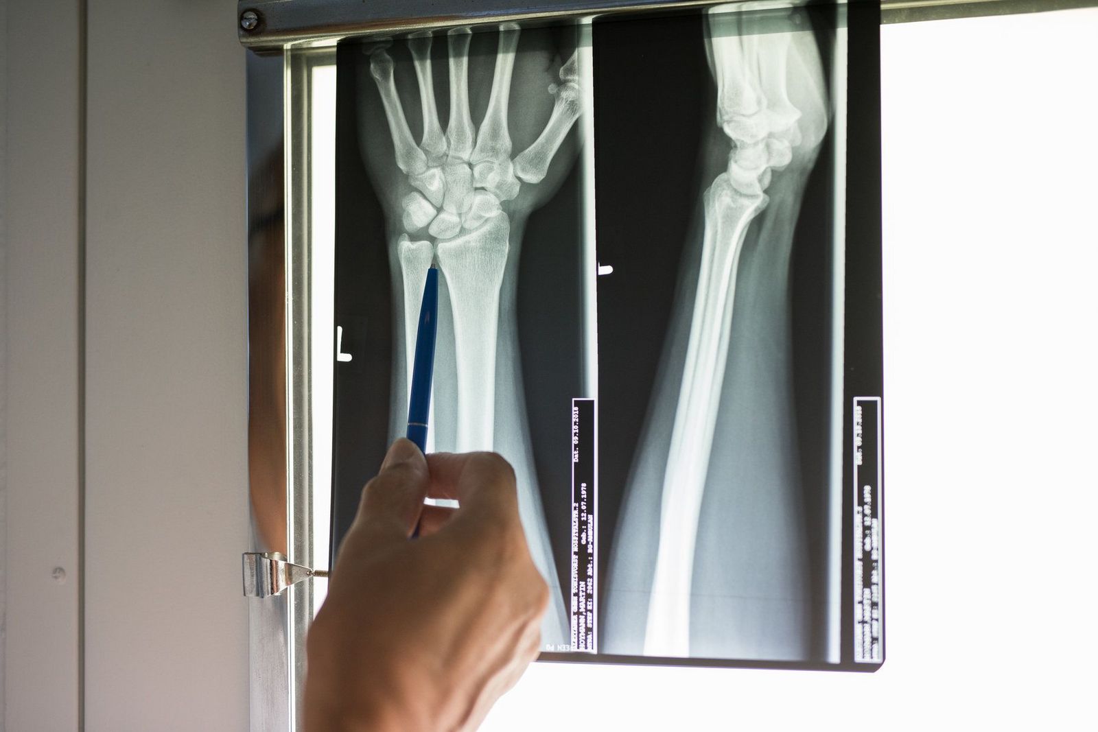 Röntgenbild eines Handgelenks